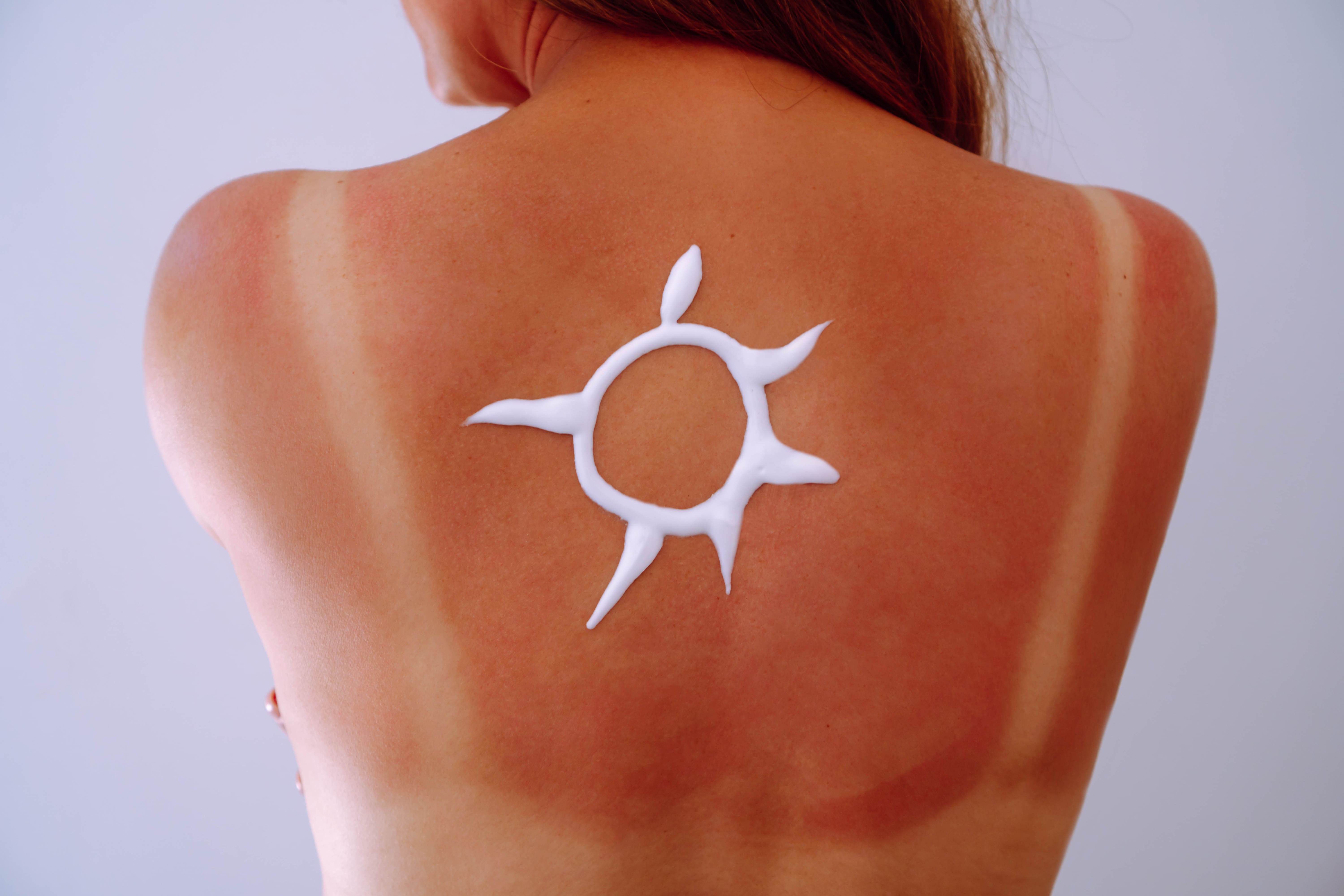 donna con eritema e protezione solare rimedi scottature solari
